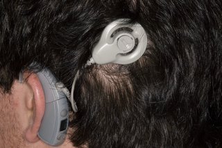 Снимка на слухов имплант на мозъчен ствол