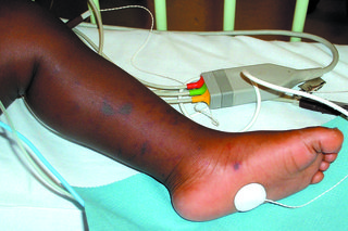Снимка на менингитен обрив по крака и стъпалото на тъмнокожо дете