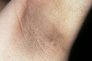 Acanthosis nigricans на подмишницата