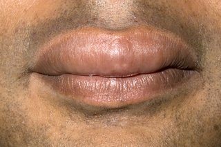 Снимка на подути устни, причинени от ангиоедем