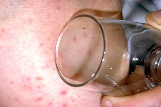 Снимка на обрив на менингит върху бяла кожа със стъкло, придържано към него